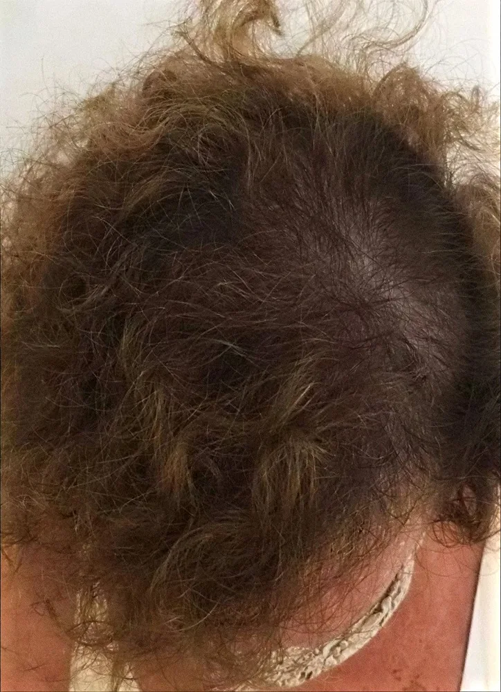 Depois: topo da cabeça coberto e com mais densidade